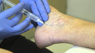 Spider Vein Treatment  Sclero Therapy [upl. by Guimar]