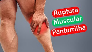 RUPTURA MUSCULAR PANTURRILHA  Dr Prof Nelson Marques [upl. by Kcajyllib]