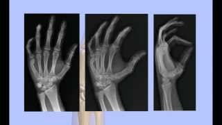 Boxers Fracture Closed Reduction [upl. by Eilyk]