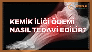 KEMİK İLİĞİ ÖDEMİ NASIL TEDAVİ EDİLİR [upl. by Notaek]