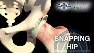 AOA Orthopedic Specialists  Snapping Hip [upl. by Akselaw869]